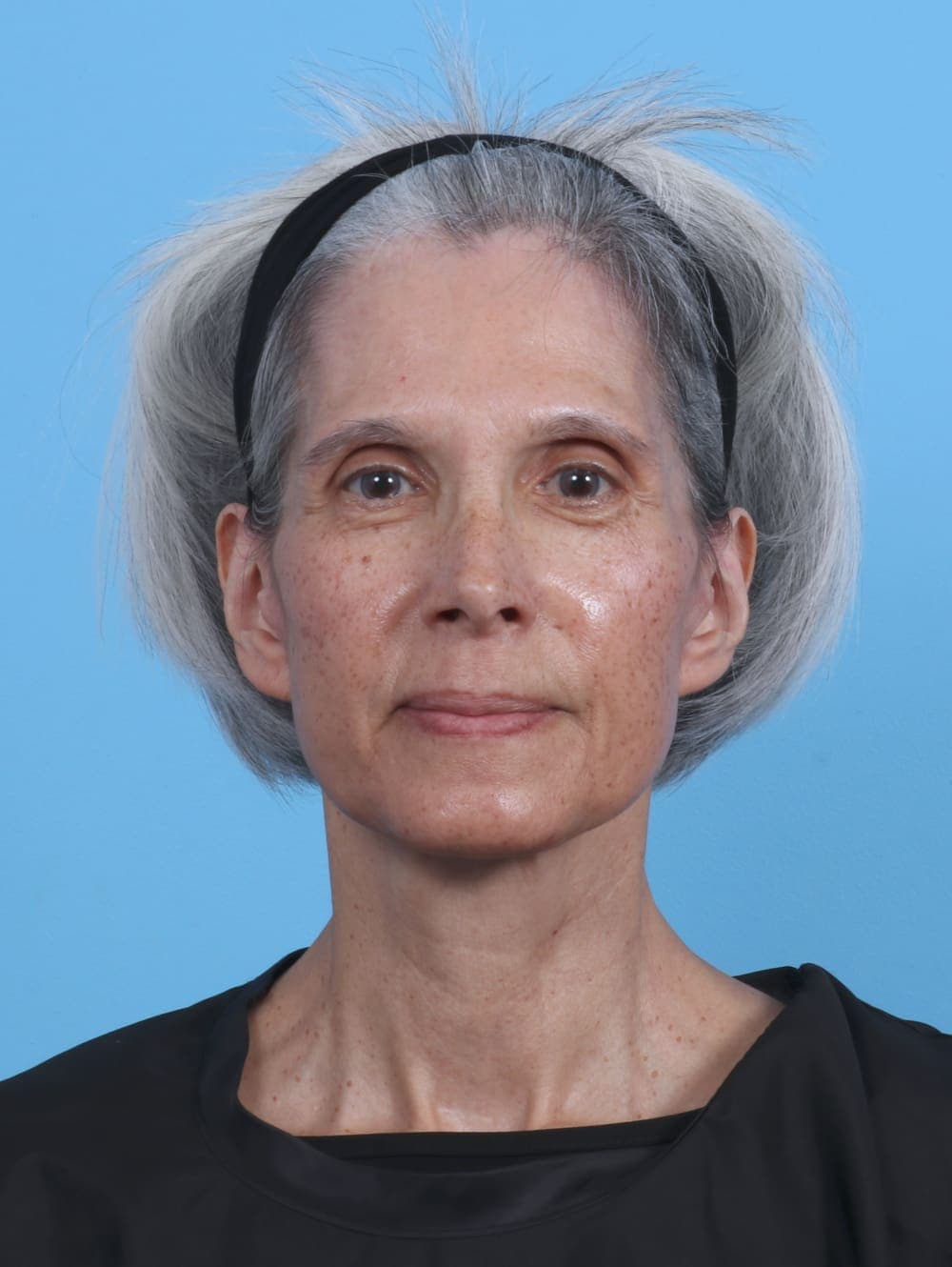Facelift case #4411 after