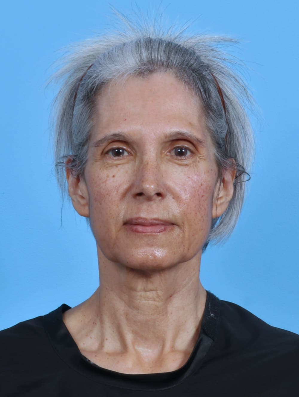Facelift case #4411 before