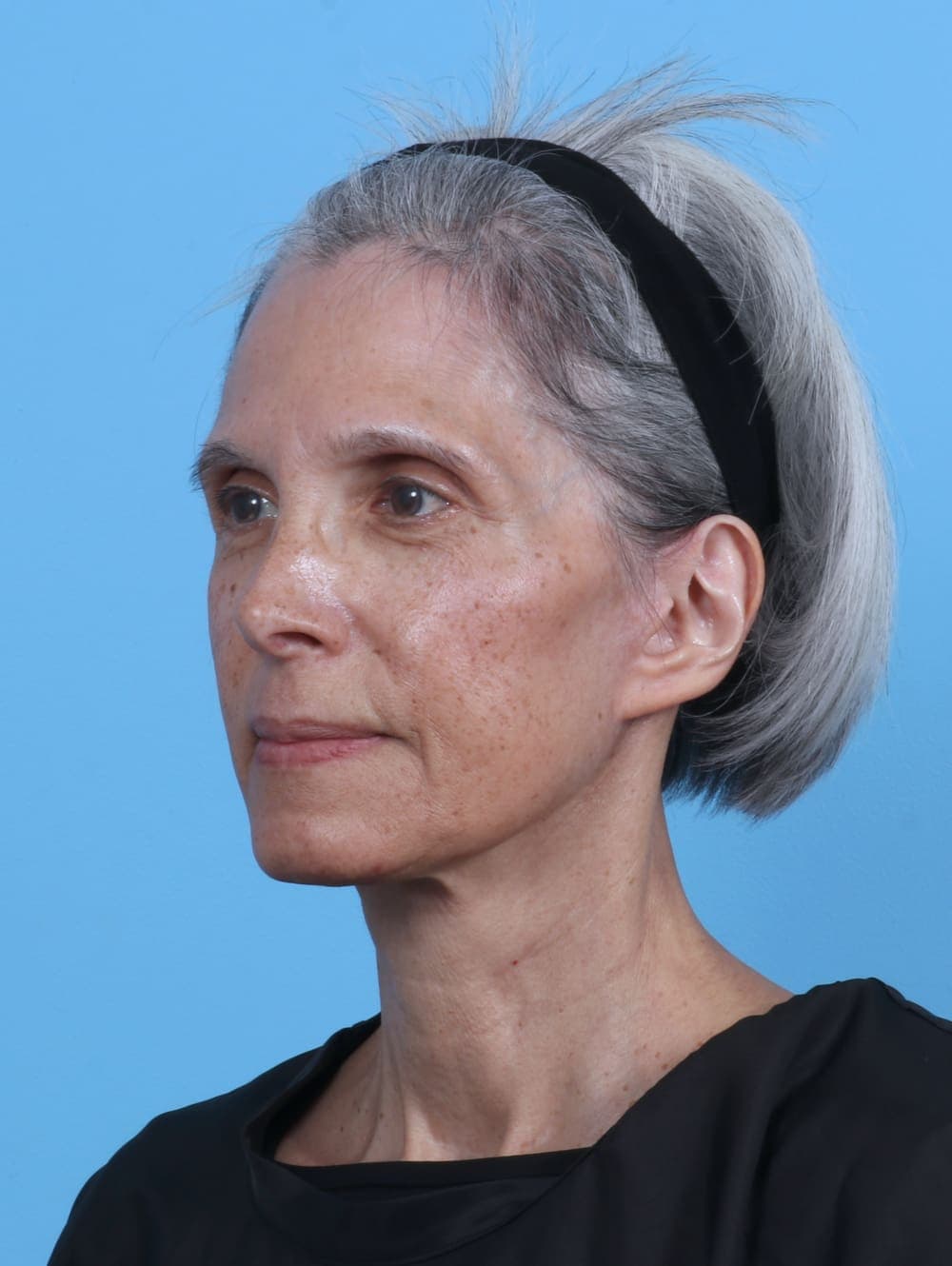 Facelift case #4411 after, image 2