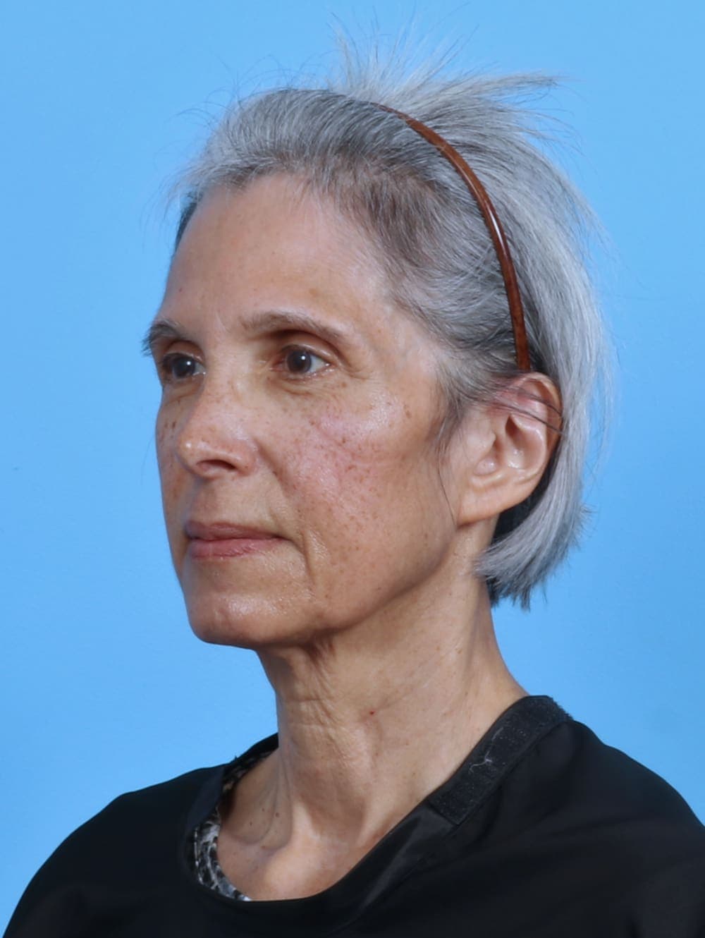 Facelift case #4411 before, image 2