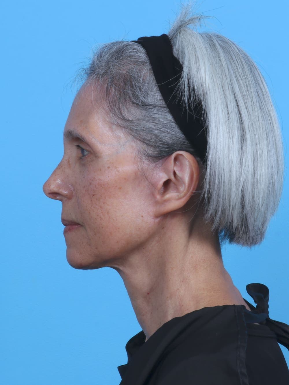Facelift case #4411 after, image 3