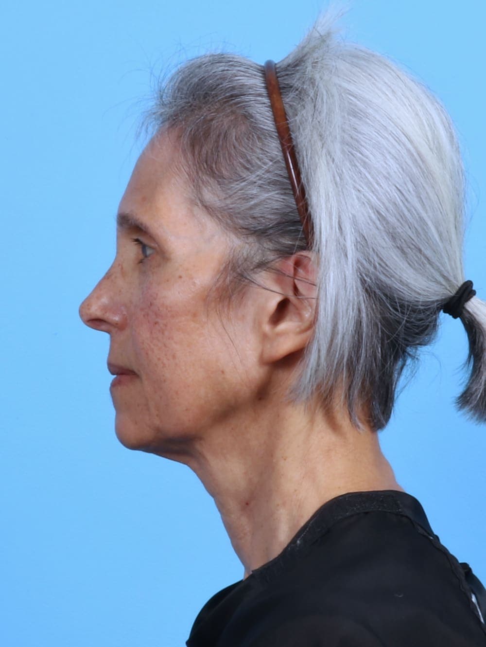 Facelift case #4411 before, image 3