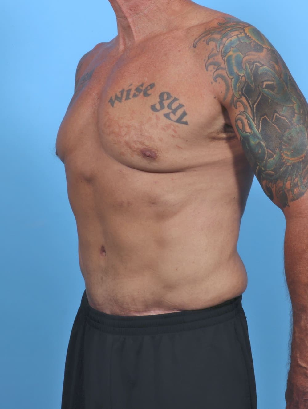 Tummy Tuck case #5610 after, image 2