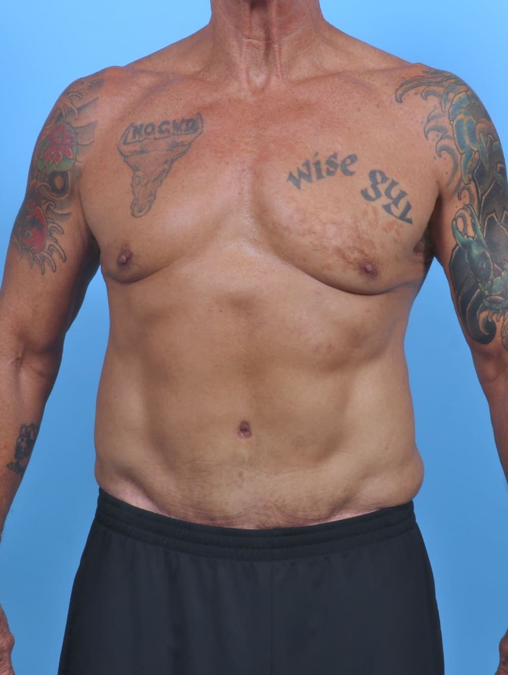 Tummy Tuck case #5610 after, image 1