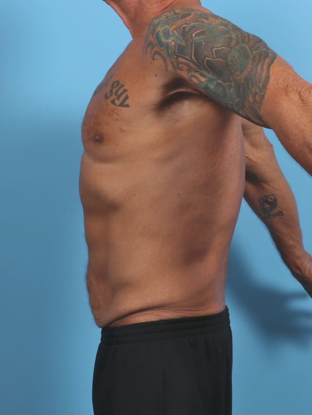 Tummy Tuck case #5610 before, image 3