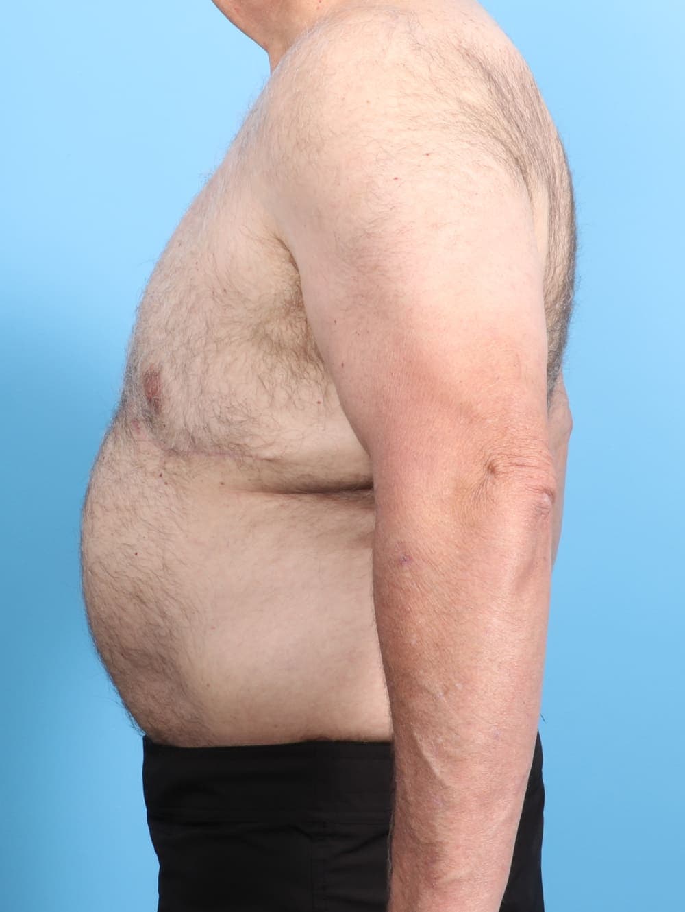 Body Lift case #2550 after, image 3