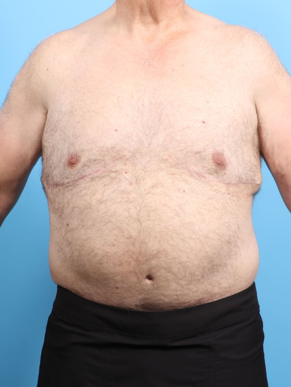 Body Lift case #2550 after, image 1