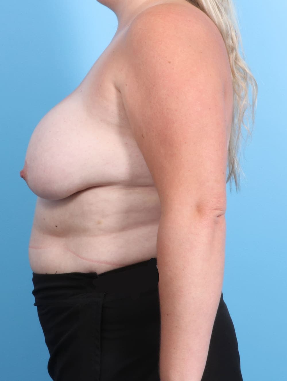 Breast Implant Revision case #2274 before, image 3