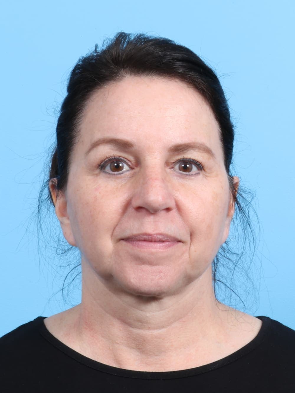 Eyelid Surgery case #2266 after, image 1