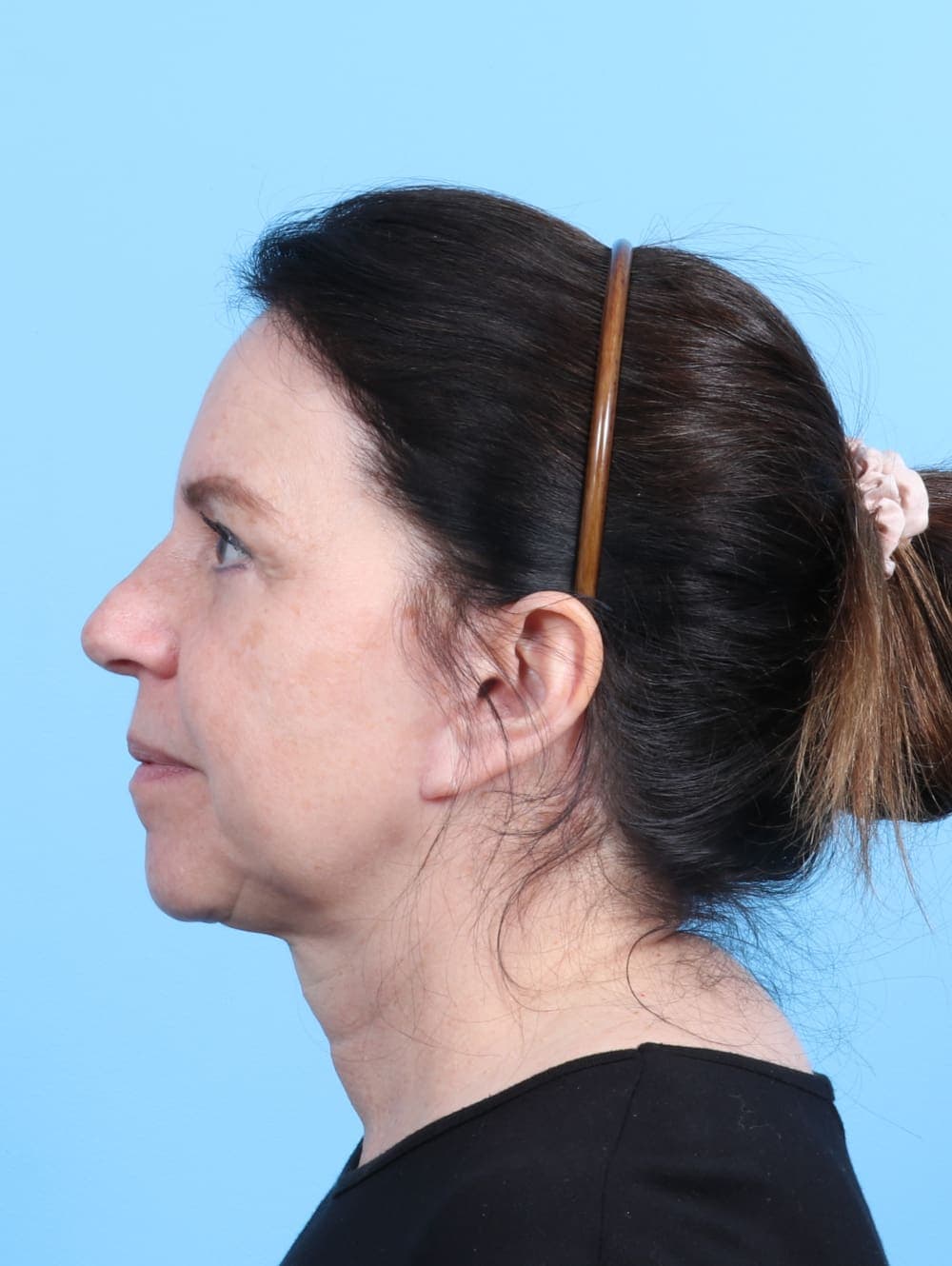 Eyelid Surgery case #2266 after, image 3
