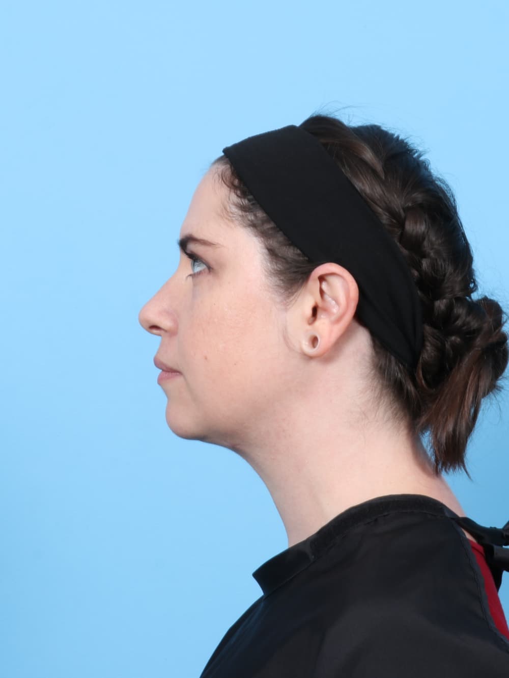 Anterior Neck Lift case #7372 after