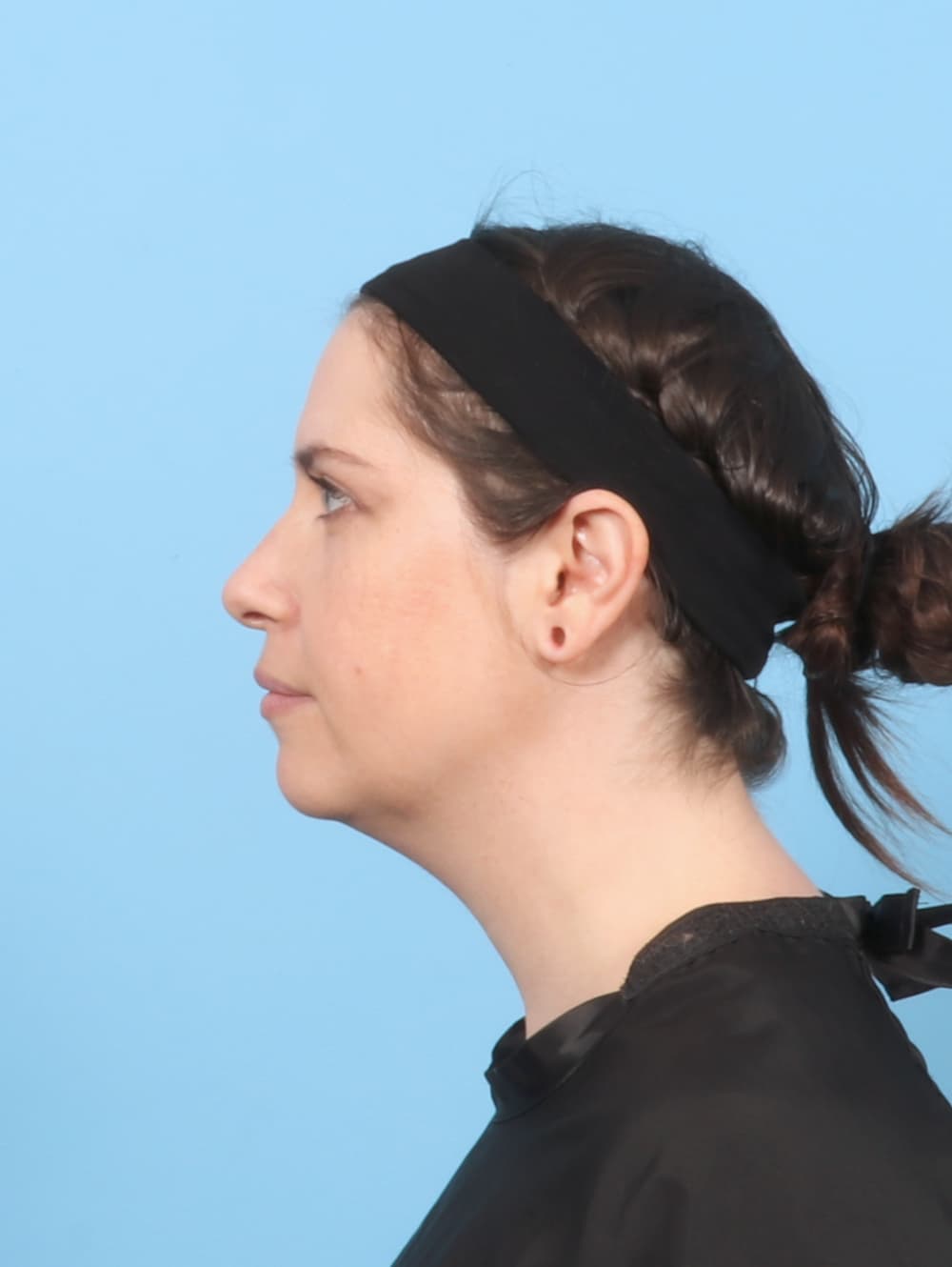 Anterior Neck Lift case #7372 before
