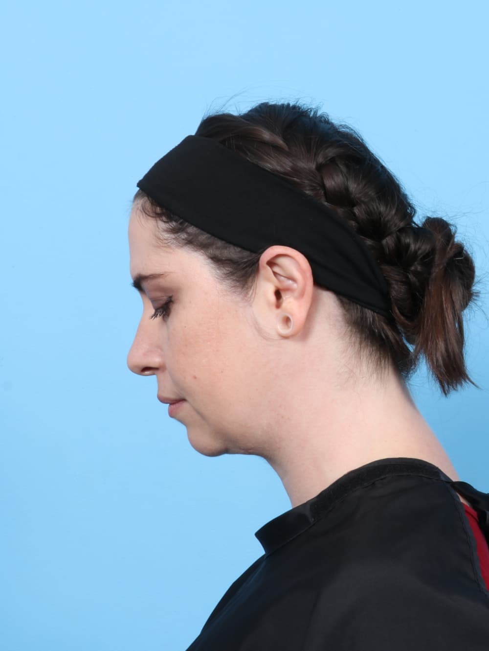 Anterior Neck Lift case #7372 after, image 2