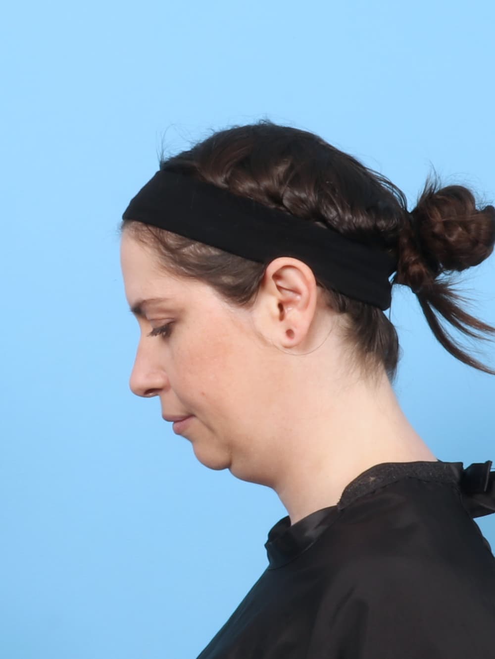 Anterior Neck Lift case #7372 before, image 2