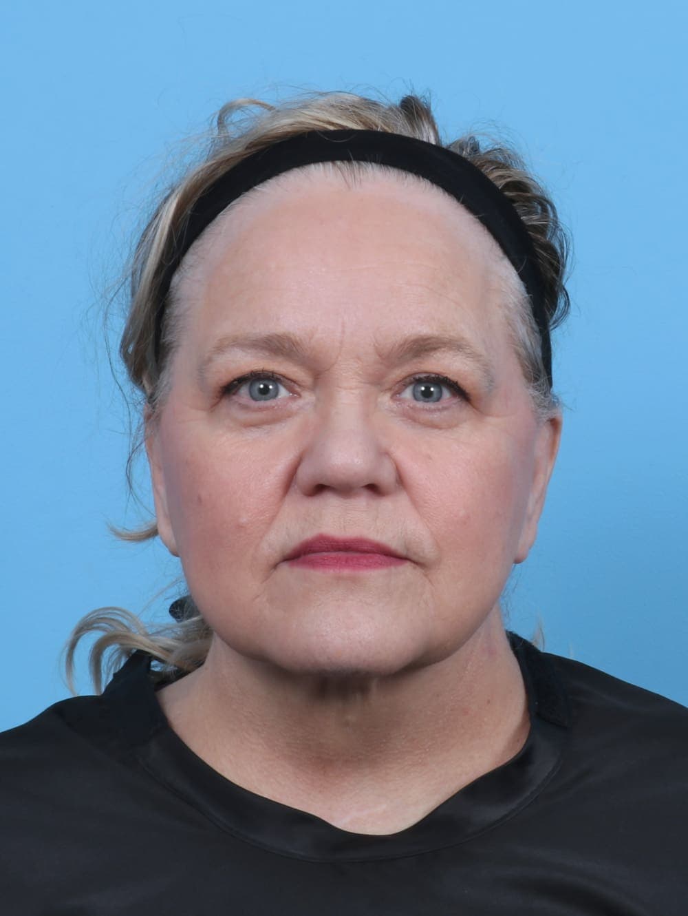 Facelift case #5668 after