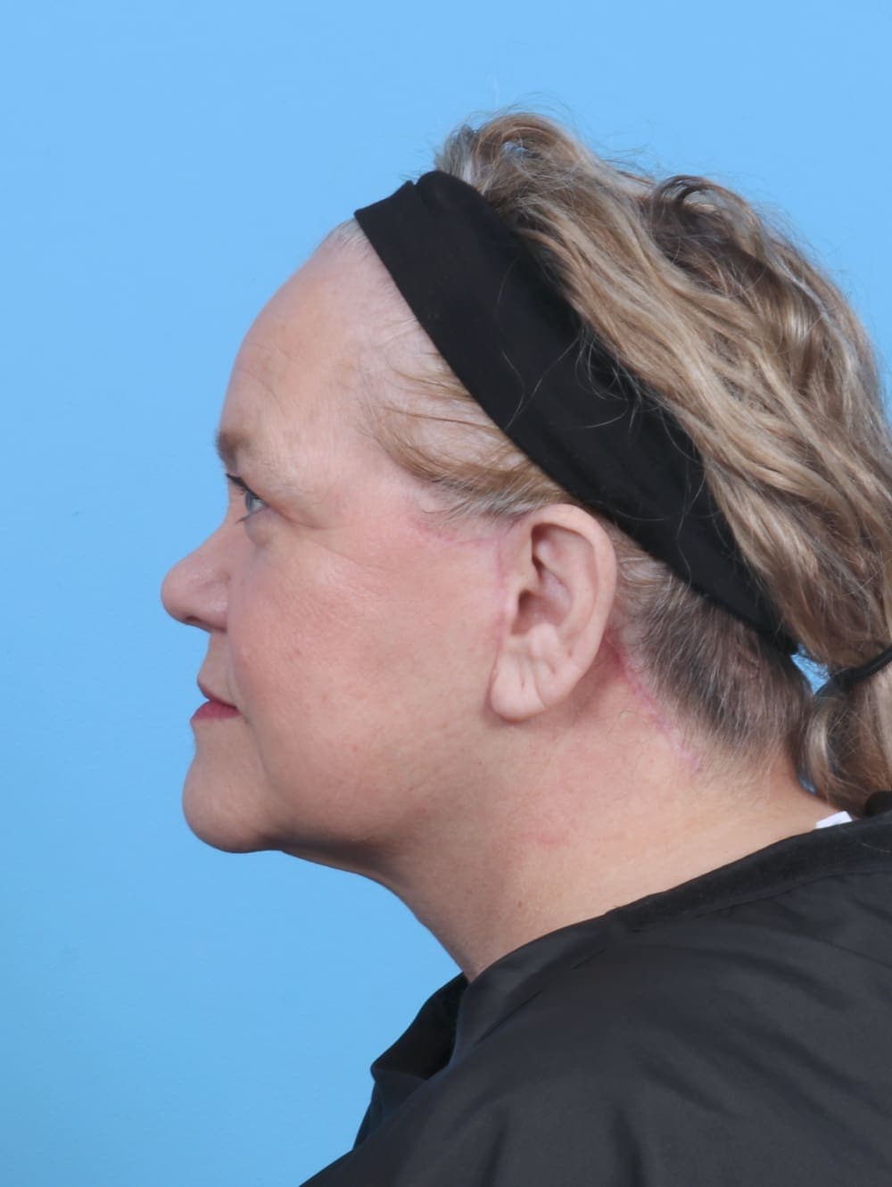 Facelift case #5668 after, image 3