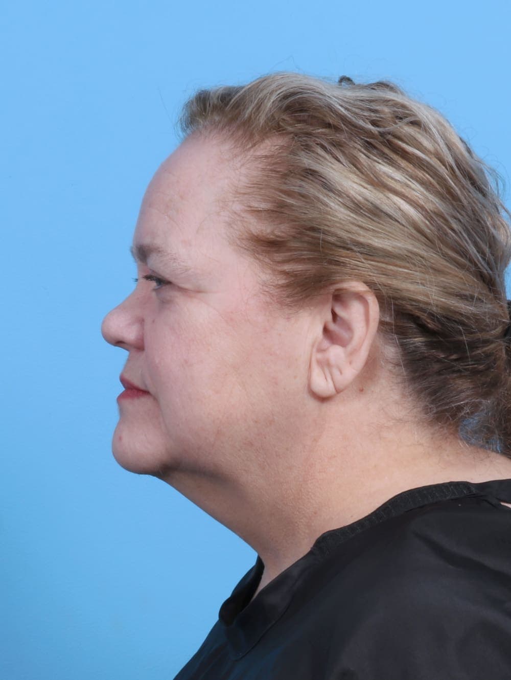 Facelift case #5668 before, image 3