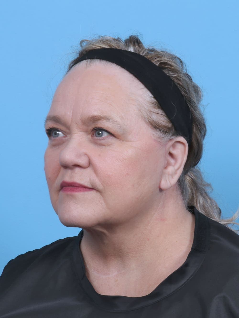 Facelift case #5668 after, image 2