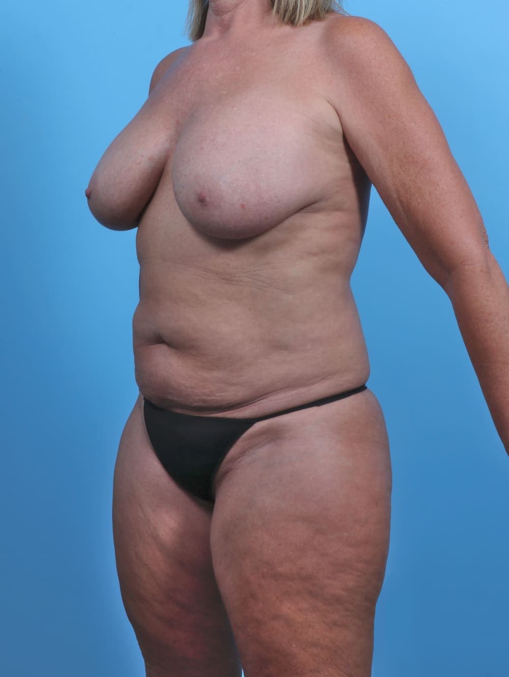 Mommy Makeover case #4991 before, image 2