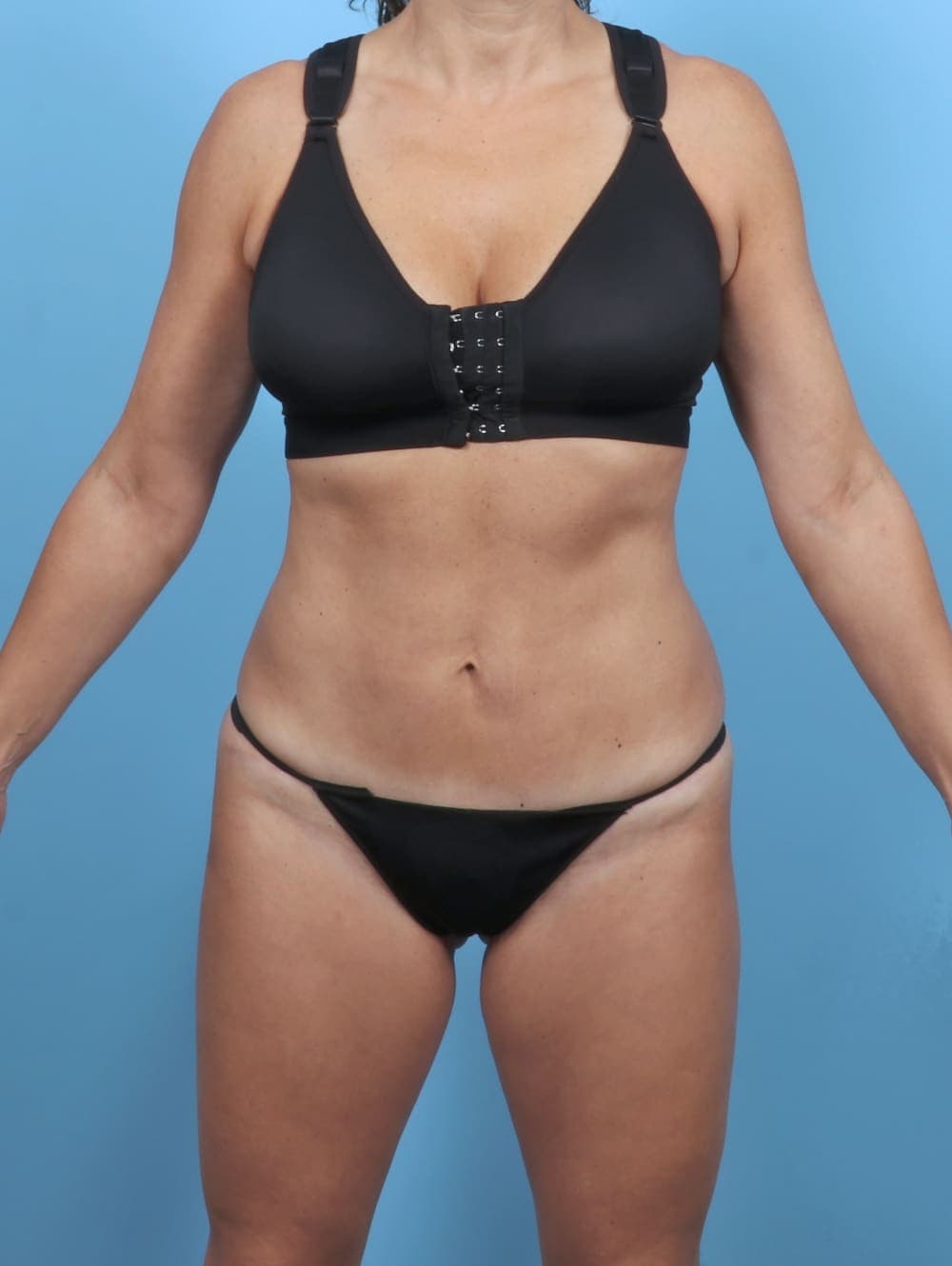 Tummy Tuck case #5857 after, image 1