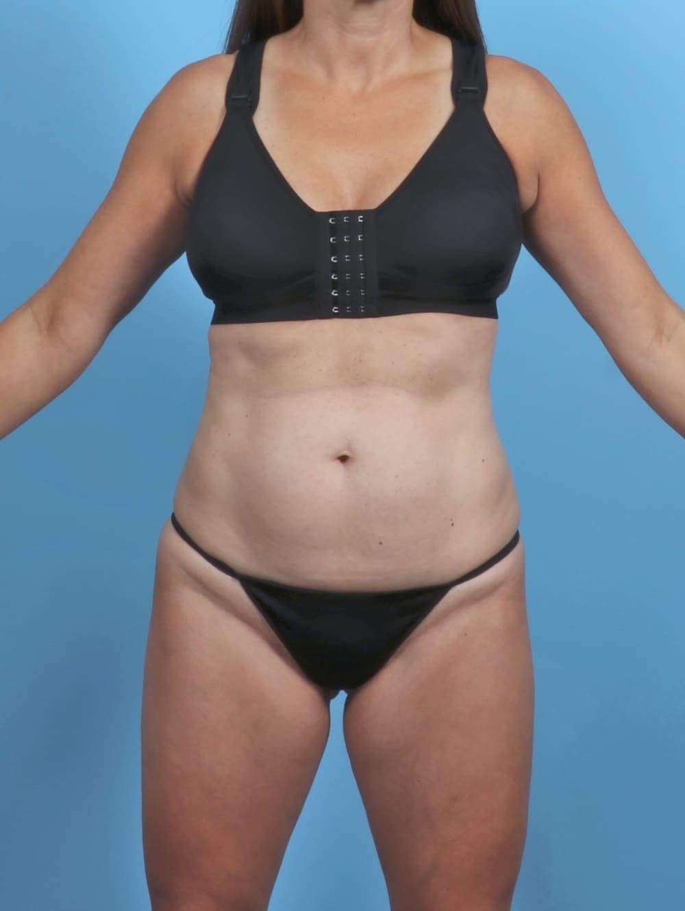 Tummy Tuck case #5857 before, image 1