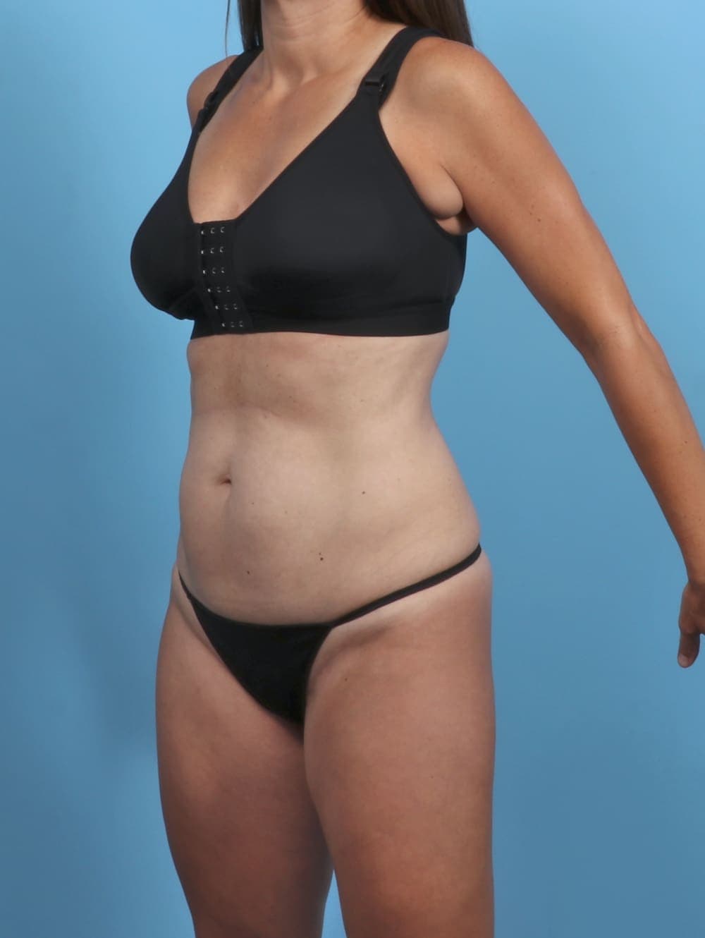 Tummy Tuck case #5857 before, image 2
