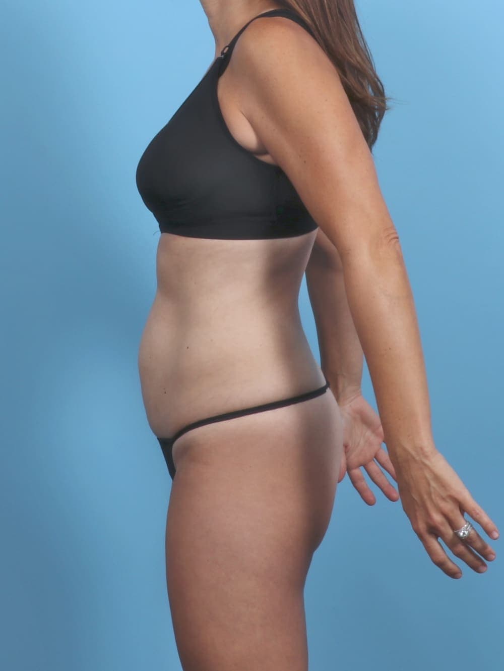 Tummy Tuck case #5857 before, image 3