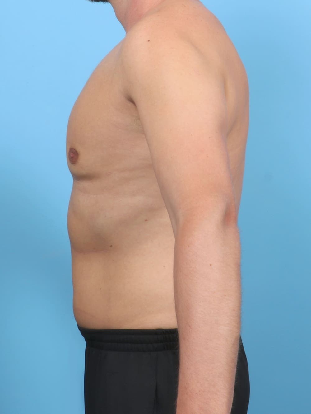 Male Breast Reduction case #5873 after, image 3