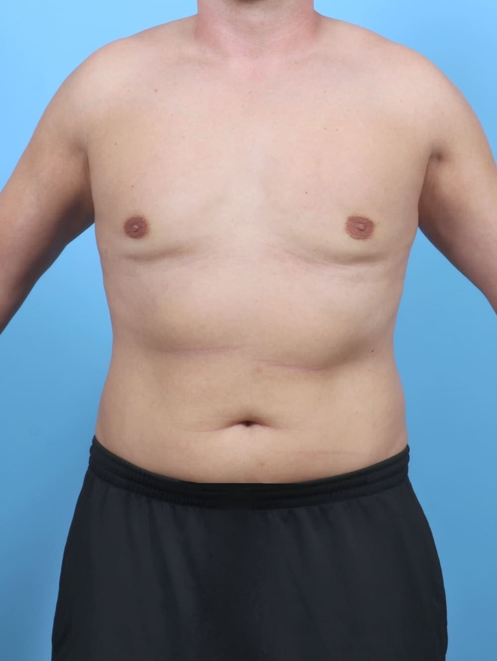 Male Breast Reduction case #5873 after, image 1