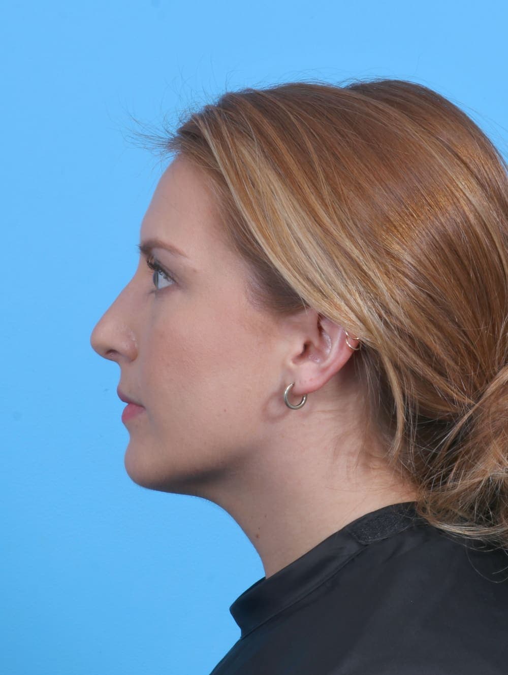 Rhinoplasty case #4229 after