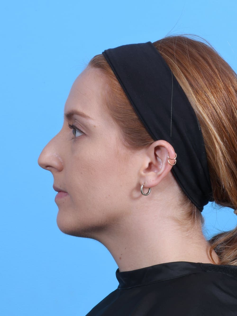 Rhinoplasty case #4229 before