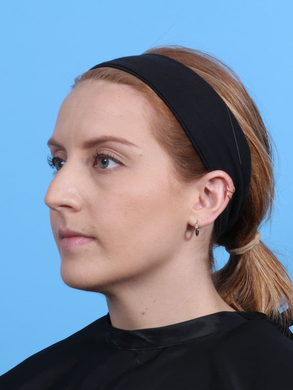 Rhinoplasty case #4229 before, image 3
