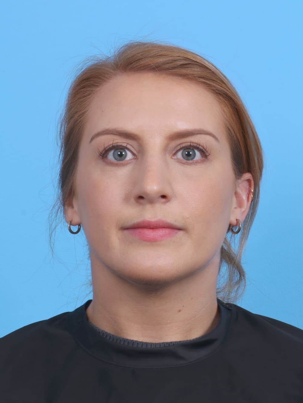 Rhinoplasty case #4229 after, image 2