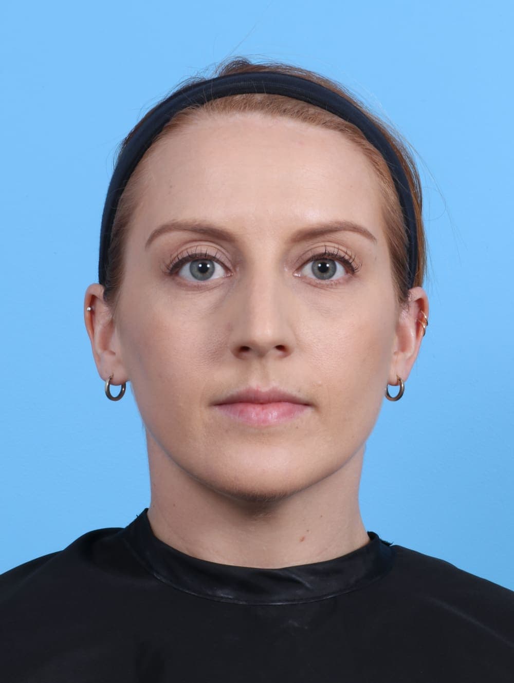 Rhinoplasty case #4229 before, image 2