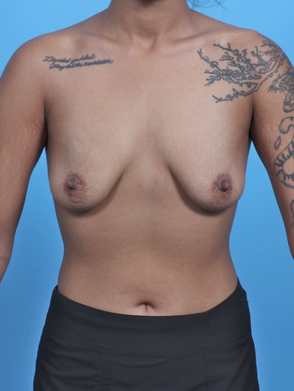 Breast Lift with Implants case #5781 before, image 1