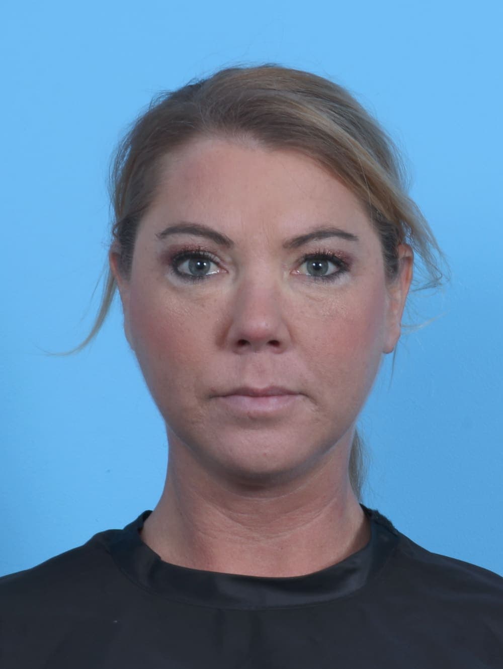 Eyelid Surgery case #4339 after, image 1