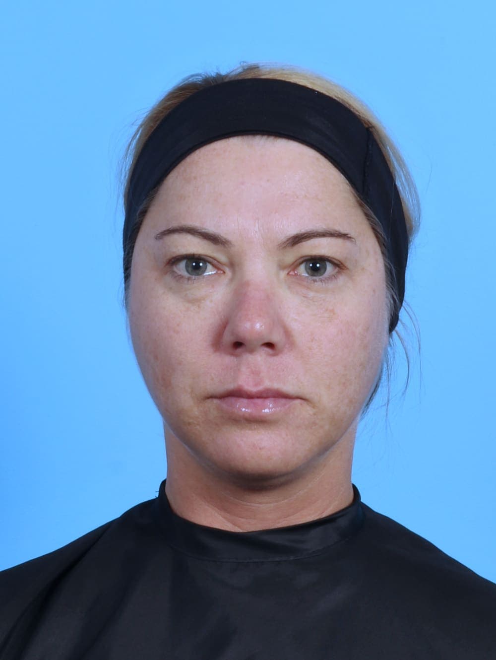 Eyelid Surgery case #4339 before, image 1