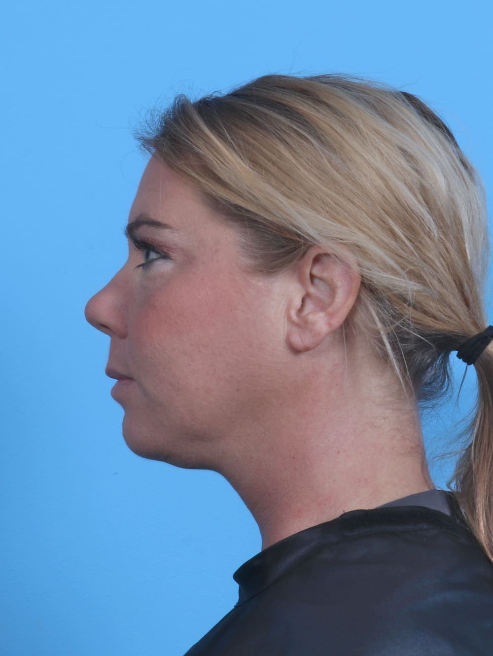 Eyelid Surgery case #4339 after, image 3