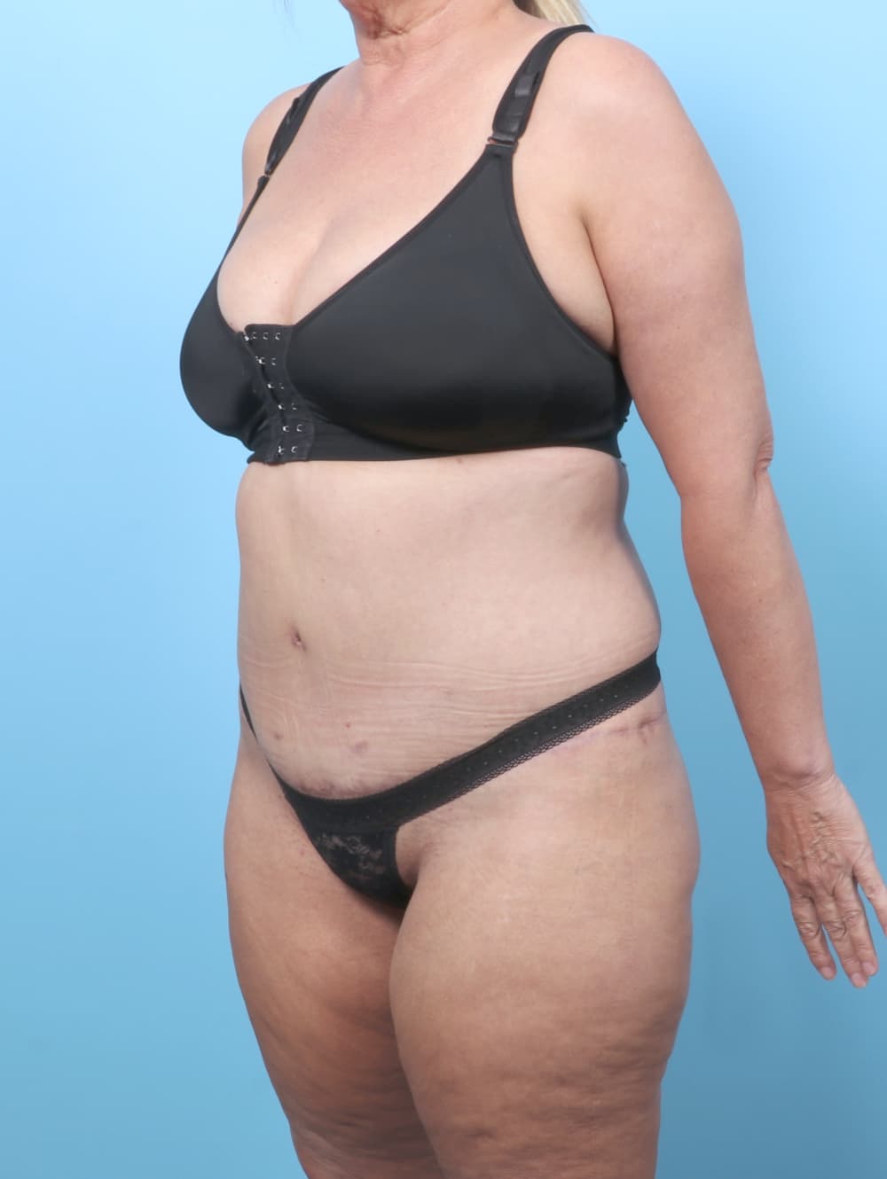 Body Lift case #8944 after, image 3