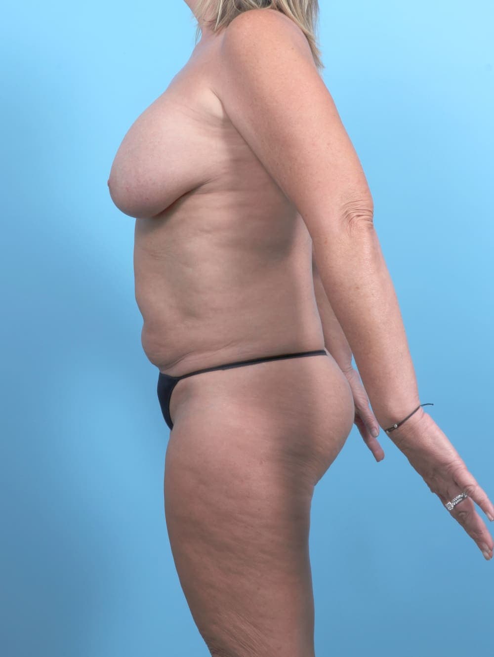Liposuction case #6693 before, image 3