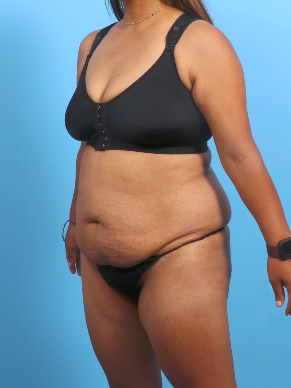 Tummy Tuck case #3327 before, image 2