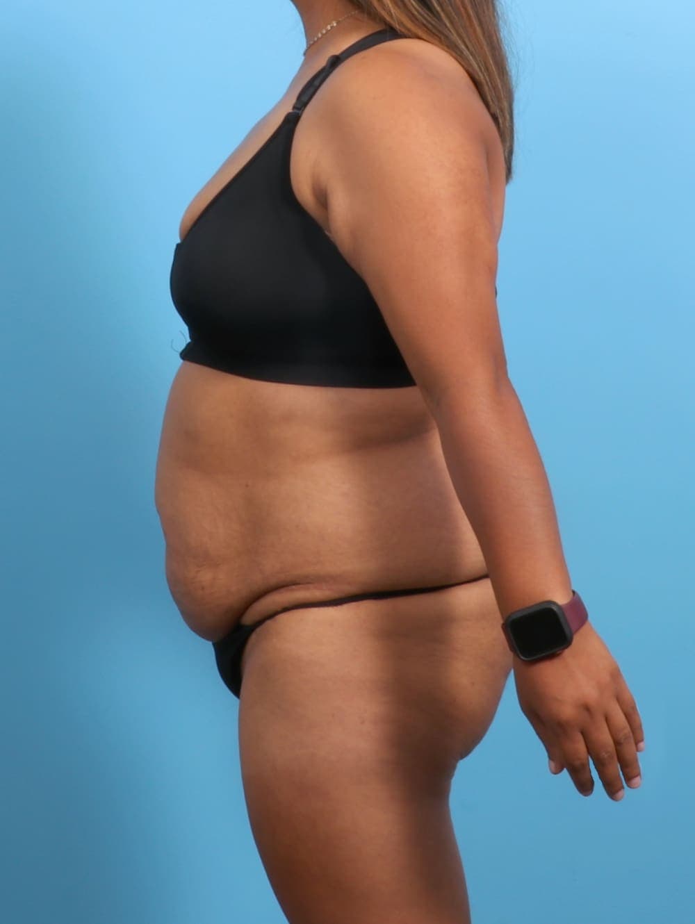 Tummy Tuck case #3327 before, image 3