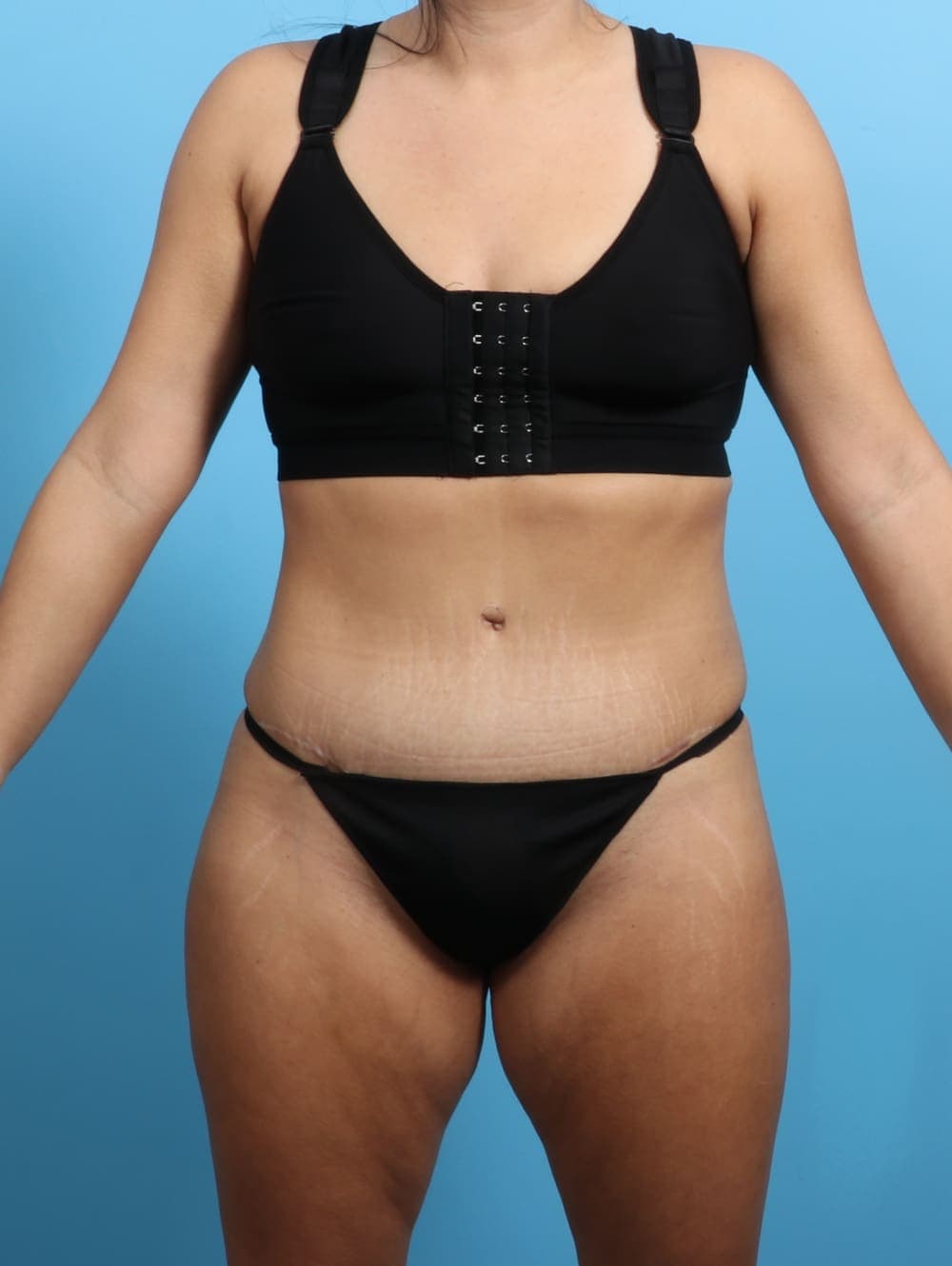 Tummy Tuck case #3026 after, image 1