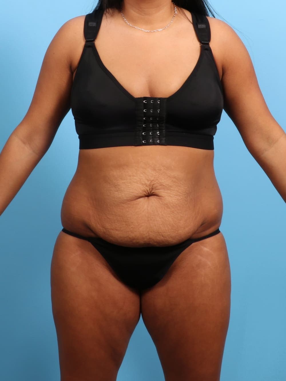 Tummy Tuck case #3026 before, image 1
