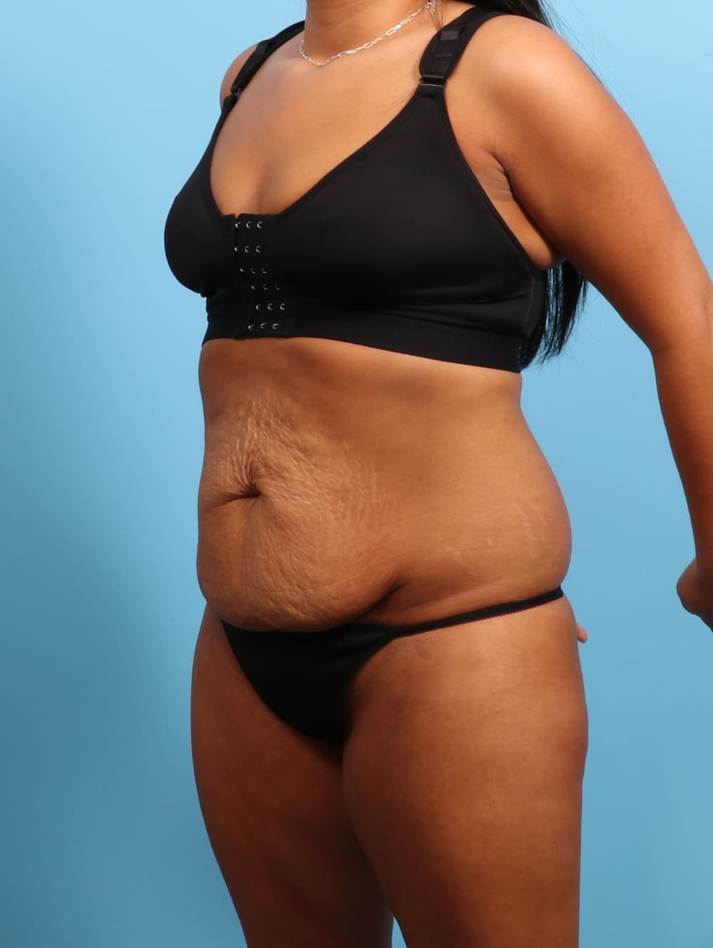 Tummy Tuck case #3026 before, image 2