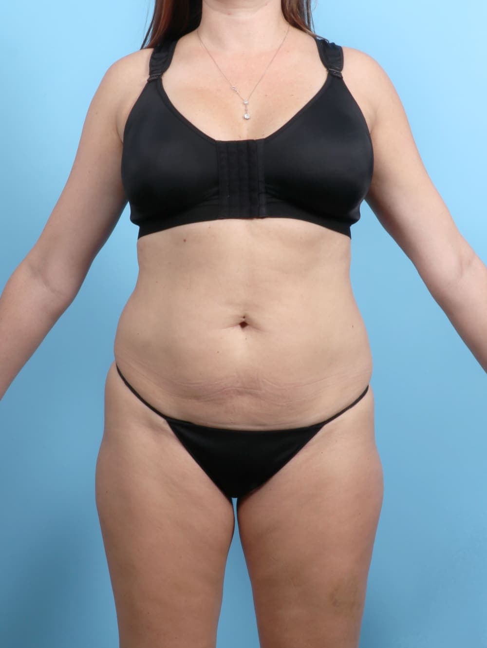 Tummy Tuck case #6767 before, image 1
