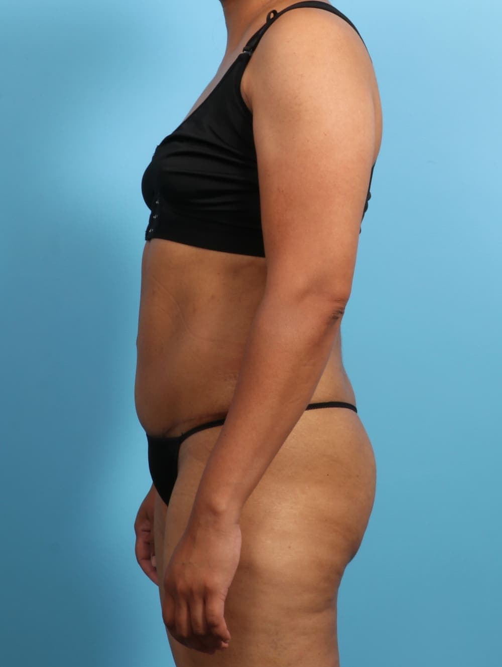Liposuction case #2711 after, image 3