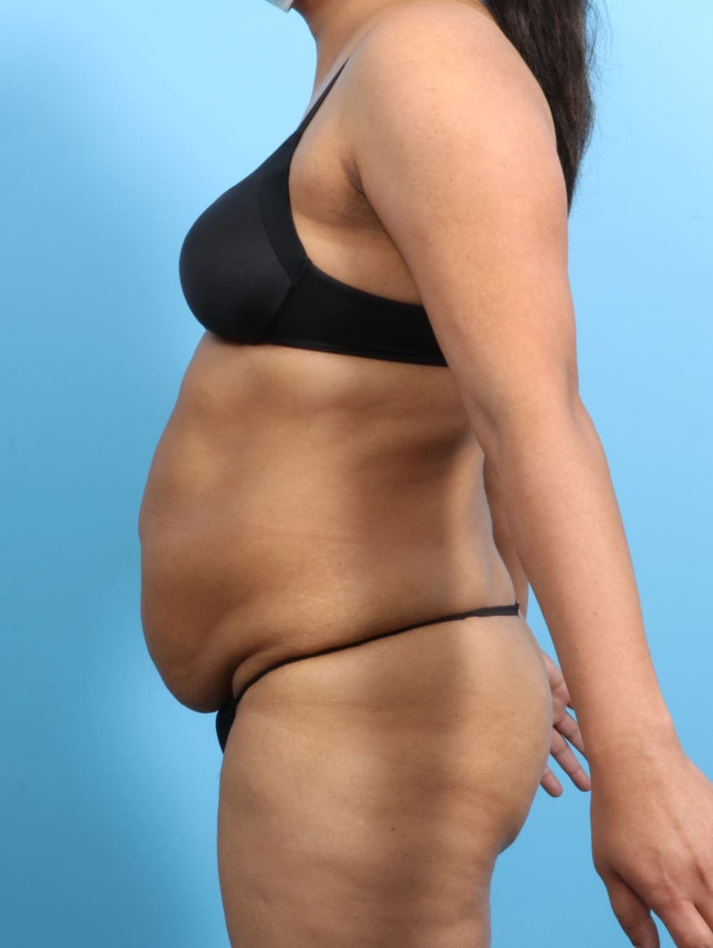 Liposuction case #2711 before, image 3