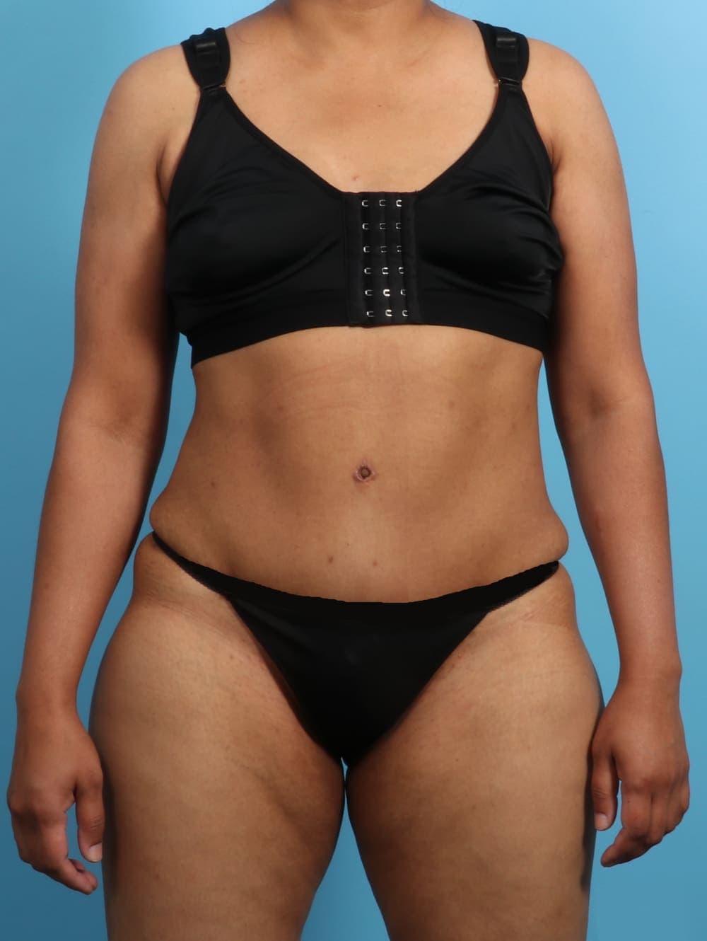 Liposuction case #2711 after, image 1