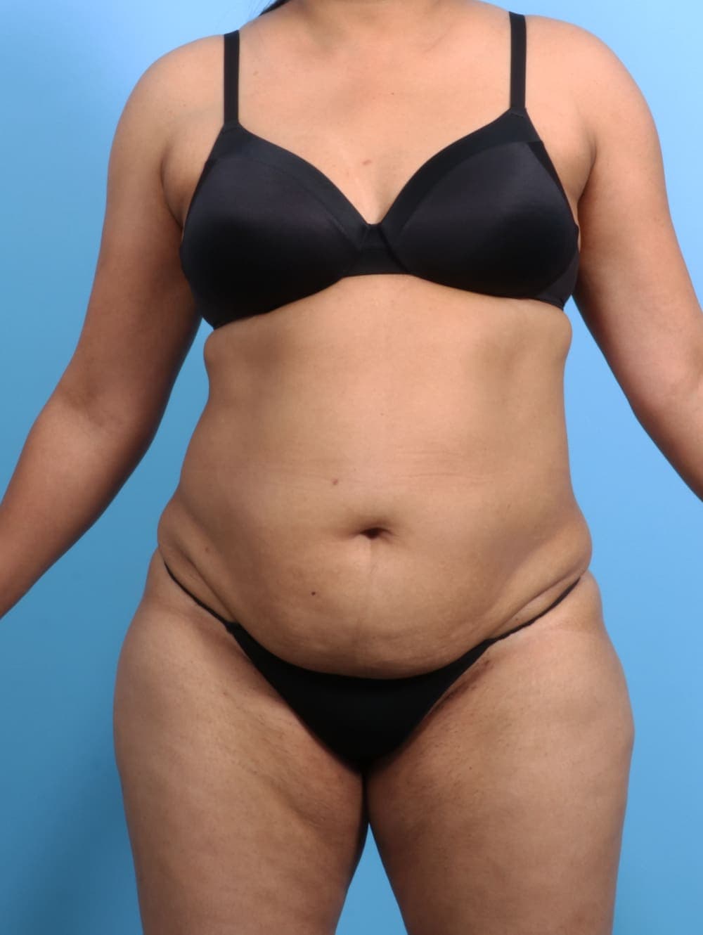Liposuction case #2711 before, image 1